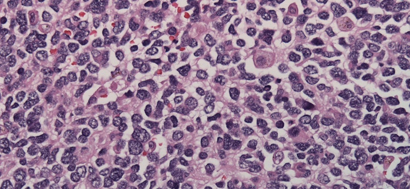 A microscopic image of neuroblastoma