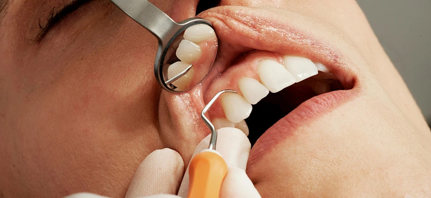 A close up of a woman getting her teeth checked with a tiny dental mirror and a sickle probe 