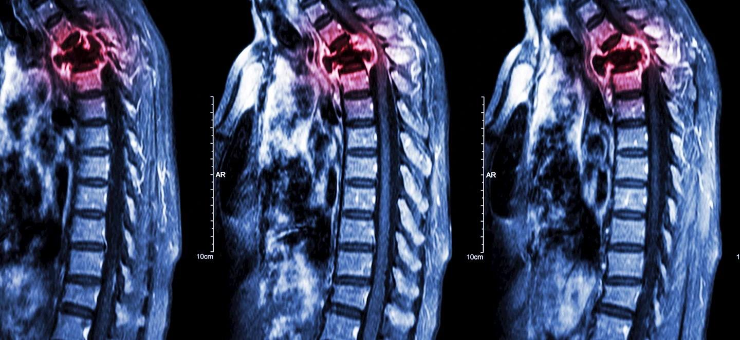 Spinal MRI showing a injury 