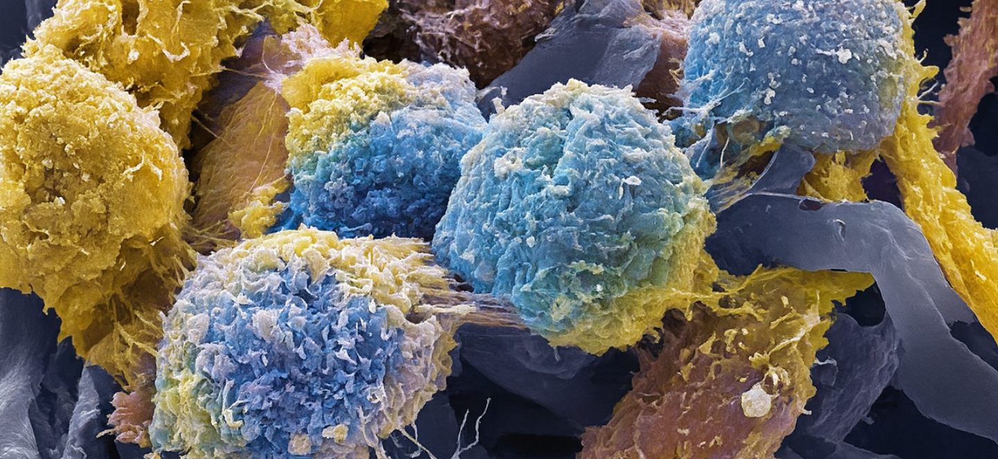 Close up of cervical cancer cells