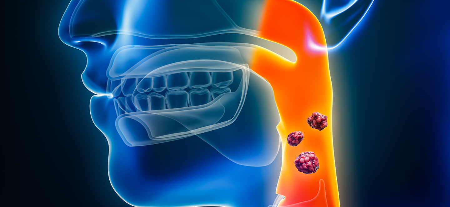 Diagram of neck cancer